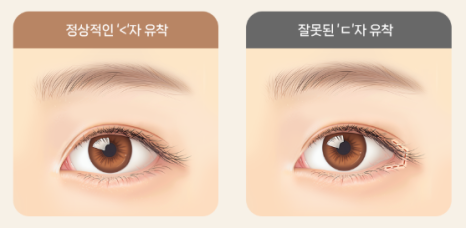 Concerned About Eyes That Look Narrow and Constricted? | When a Lateral Canthoplasty & Lower Canthoplasty May Be Needed at Baba Plastic Surgery Clinic image 8