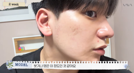 무보형물 직선라인 코성형으로 주먹코&middot;복코 개선｜압구정 바바성형외과 사례 관련 이미지 23