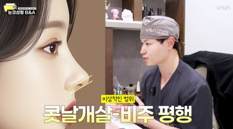 복코 매부리코 긴코 교정 ㅣ 코성형 전후 케이스 (NJZ민지 코) 관련 이미지 19