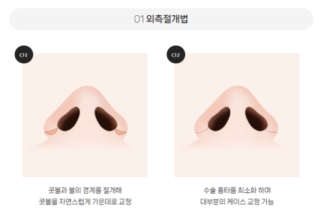 Concerned About Wide Nostrils? | When Alar Reduction Is Needed at BABA Plastic Surgery image 7