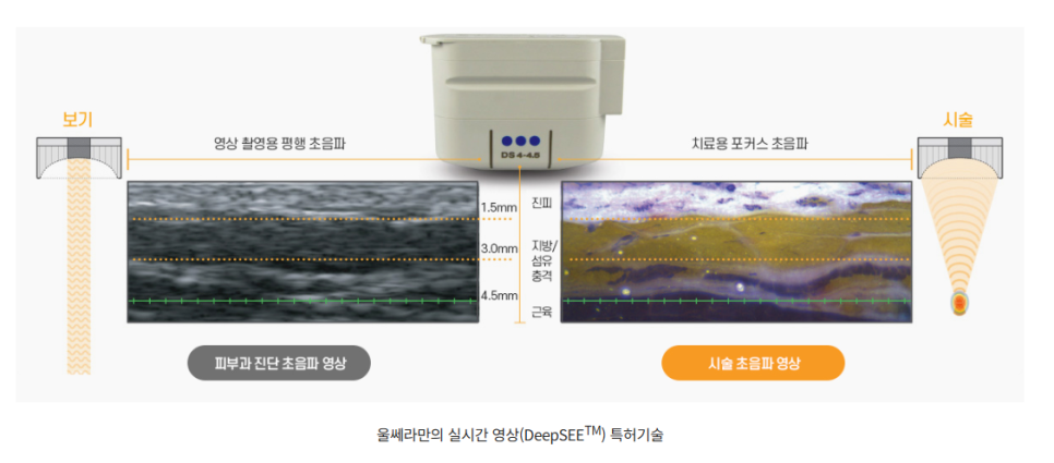 울쎄라 효과 언제부터? 윤곽까지 바뀌는 리프팅, 압구정 바바성형외과(리얼후기) 관련 이미지 10