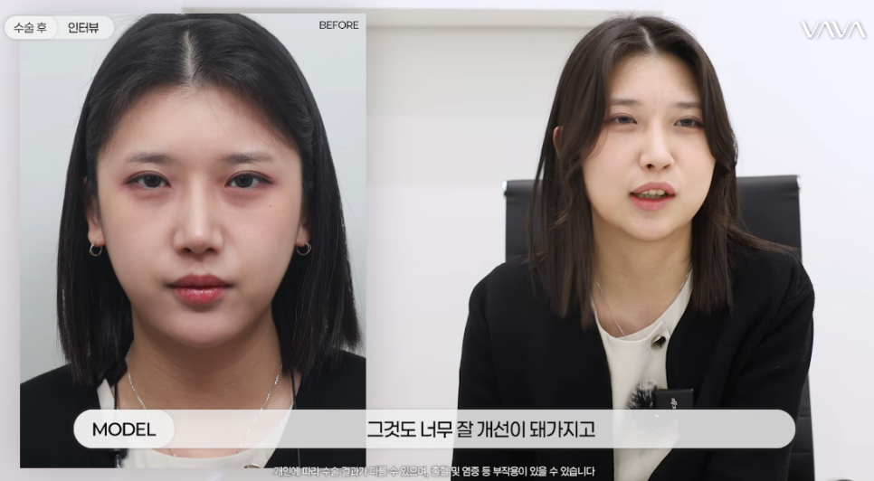 눈이랑 코 같이 하면 더 예뻐질까? ㅣ  동시성형 솔직 정리 관련 이미지 6