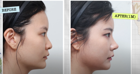 바바성형외과 복코&middot;매부리코&middot;휜코 동시 교정! 직반라인 코성형 리얼 후기 관련 이미지 17