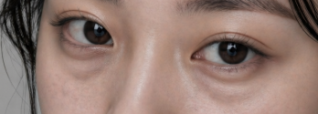 눈밑지방재배치 이거 모르고 하면 티 납니다 ㅣ  눈밑지방재배치 잘 되는 기준 관련 이미지 7