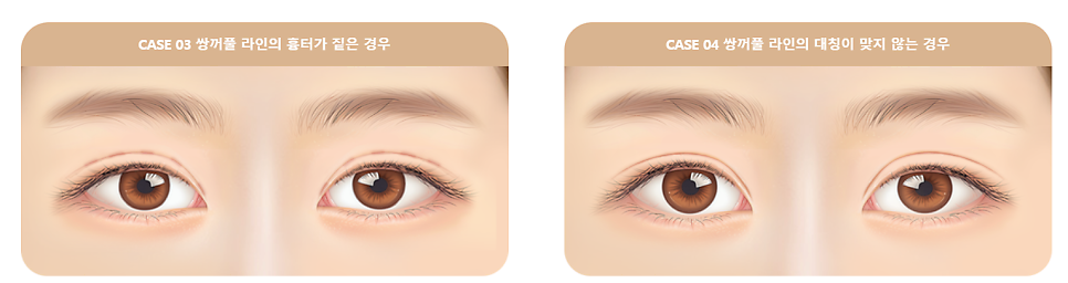 눈 재수술로 보다 완벽한 눈매라인 되찾기 관련 이미지 3