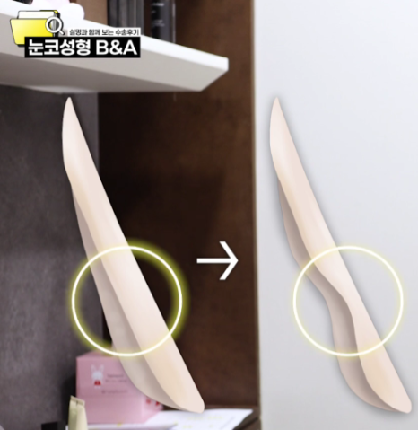 복코 매부리코 긴코 교정 ㅣ 코성형 전후 케이스 (NJZ민지 코) 관련 이미지 16