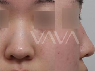 복코 수술전후 개선 된 인상 관련 이미지 5