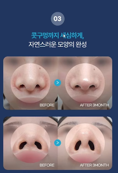 압구정 바바성형외과 코성형 &ndash; 정면&middot;측면 모두 고려한 코라인 설계 관련 이미지 12