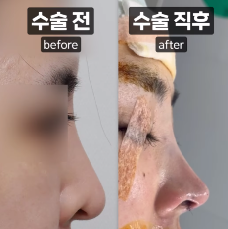 코끝 처짐 없이 자연스러운 맞춤 라인으로 관련 이미지 3