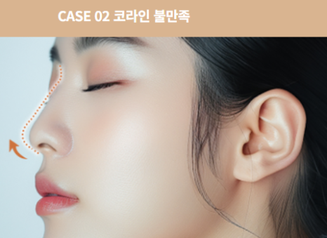 코 재수술, 첫 수술보다 더 신중해야 하는 이유 관련 이미지 7