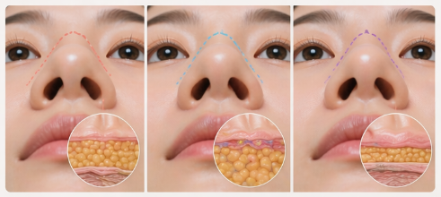 코수술 붓기 기간, 언제 빠질까? ㅣ회복기간&middot;코끝 붓기까지 정리 관련 이미지 4
