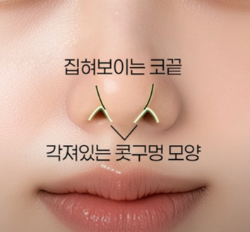 세련된 코끝 + 콧대라인, 바바성형외과의 트렌디 코성형 노하우 관련 이미지 7