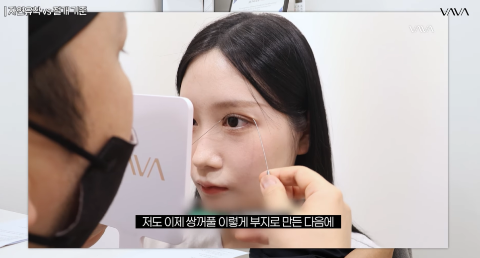 자연유착 VS 절개  어떤 기준으로 선택해야 할까? 관련 이미지 2