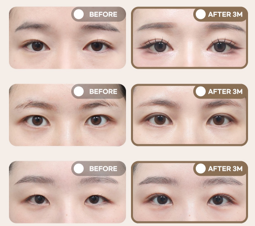 겨울방학 쌍꺼풀 수술, 이것만은 꼭 알아두세요｜쌍꺼풀 수술 가이드 관련 이미지 14