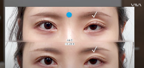 쌍수 후 생겨버린 짝눈 교정 눈의 균형을 맞추는 섬세한 방식 관련 이미지 14