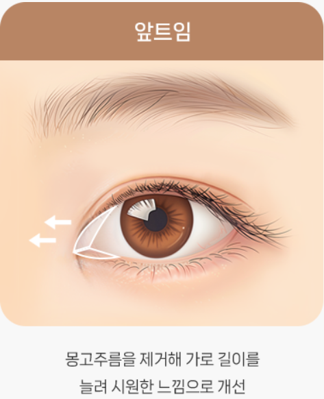 트임이 필요한 눈매와 트임 수술법 관련 이미지 2