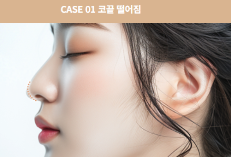 코 재수술, 첫 수술보다 더 신중해야 하는 이유 관련 이미지 6