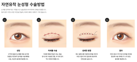 쌍꺼풀 수술만으로 충분할까? 눈 트임이 필요한 경우 관련 이미지 8