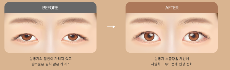 졸려 보이는 눈 안검하수 절개 쌍수 전후 차이 관련 이미지 2
