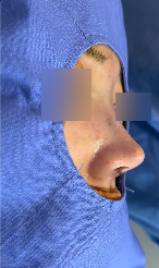 복코 수술전후 개선 된 인상 관련 이미지 7