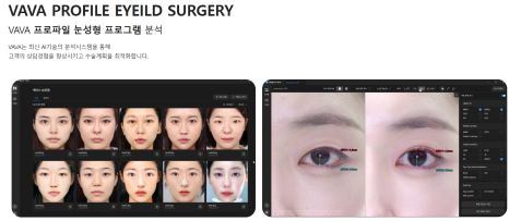 눈 재수술로 보다 완벽한 눈매라인 되찾기 관련 이미지 11