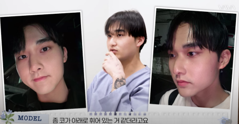 남자 코성형 리얼 후기 한 달 차 사례 비교해 보며 분석하기 관련 이미지 3