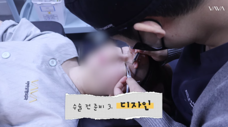 졸려보이는 눈 자연유착 밑트임 위트임으로 또렷하게 (리얼 후기) 관련 이미지 8