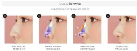 복코, 매부리코, 낮은코 | 바바성형외과 유형별 코성형, 내 코에 맞는 방향 찾기 관련 이미지 11