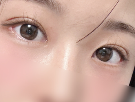 여름철 휴가 전 쌍꺼풀 수술 붓기 관리와 회복 TIP 관련 이미지 14