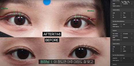 바바성형외과 절개 쌍수 절개 눈매교정 쌍꺼풀  재수술  사례 관련 이미지 17