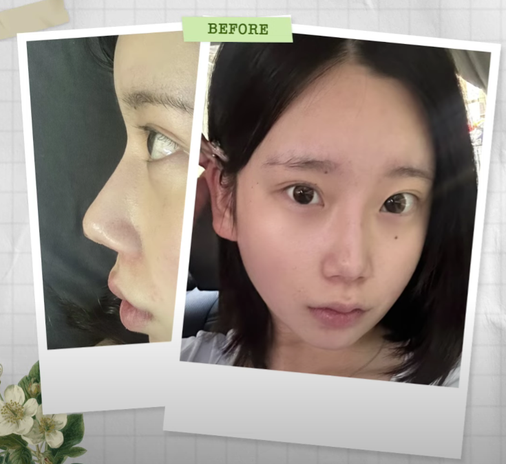 바바성형외과 눈&middot;코 성형 한 달 차 리얼 케이스 (윈터, 카리나 코) 관련 이미지 2