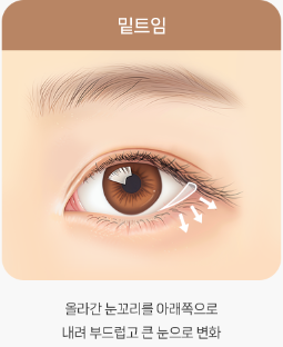 트임이 필요한 눈매와 트임 수술법 관련 이미지 8