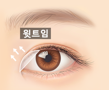 자연유착 VS 절개  어떤 기준으로 선택해야 할까? 관련 이미지 21