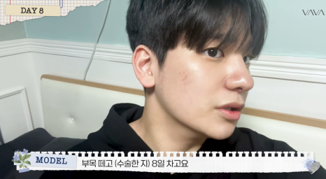 무보형물 직선라인 코성형으로 주먹코&middot;복코 개선｜압구정 바바성형외과 사례 관련 이미지 22