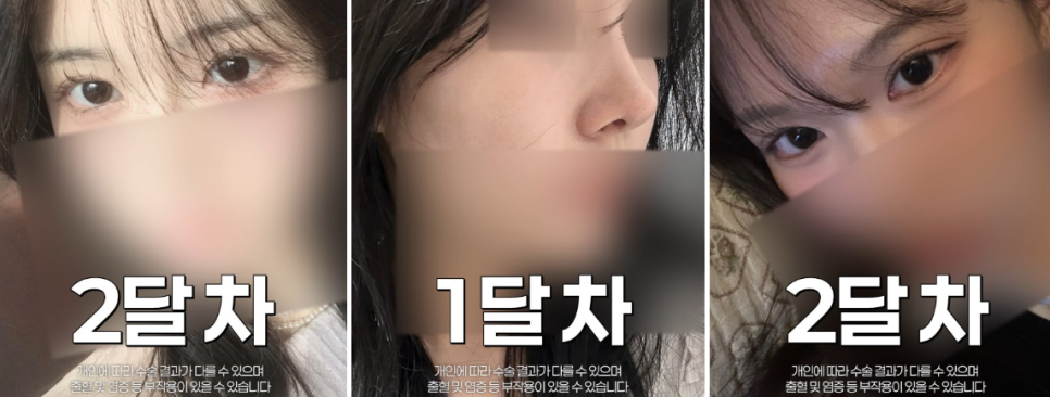 여름 쌍꺼풀 수술, 왜 오히려 더 추천할 수도 있을까? 바바성형외과에서 알려드립니다. 관련 이미지 13