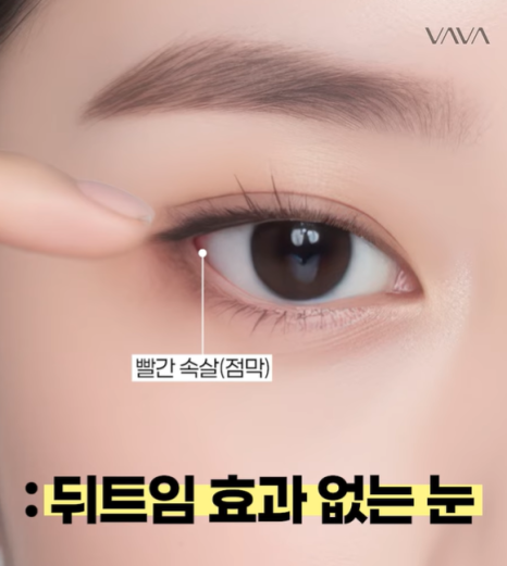 뒤밑트임 수술, 잘 되는 눈 따로 있습니다｜추천 대상&middot;부작용&middot;재유착 정리 관련 이미지 16