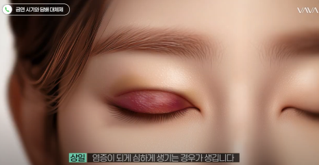 쌍수 코 수술 후 주의사항 관리방법  (당일세안 , 실밥 제거 , 안연고 바르기) 관련 이미지 13