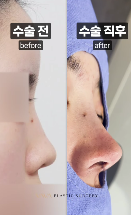 화려와 자연스러움의 중간 자려라인의 정석 직반라인 코 성형 관련 이미지 12