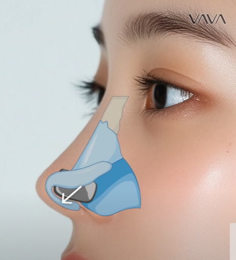 압구정 바바성형외과 | 코성형의 핵심, 비주의 중요성과 교정 방법 관련 이미지 13