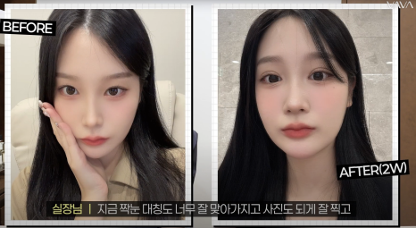 바바성형외과 절개 쌍수 절개 눈매교정 쌍꺼풀  재수술  사례 관련 이미지 18