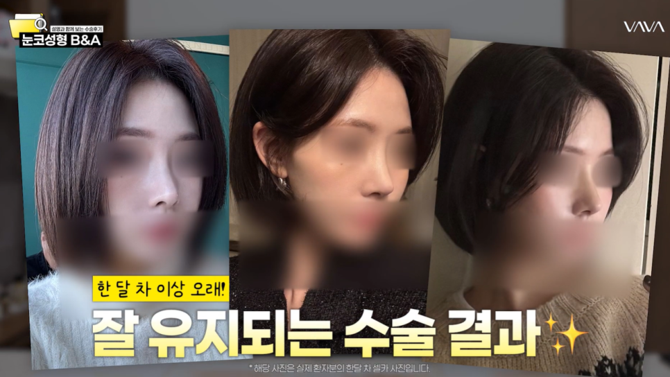 2026년 코성형 트렌드 예측콧대에서 코끝, 그리고 콧구멍까지 보는 시대 관련 이미지 18