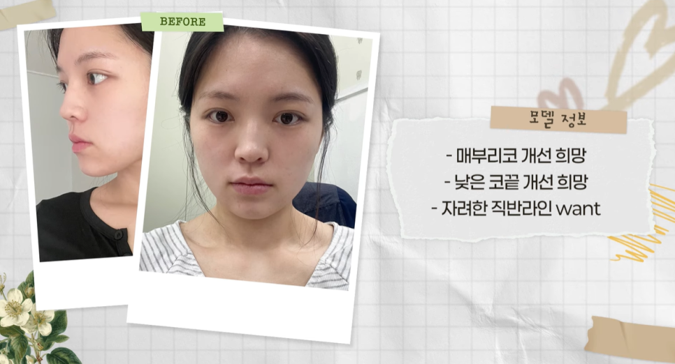 보형물 없이 선명하게｜바바성형외과 무보형물 매부리코 교정 리얼 후기 관련 이미지 2