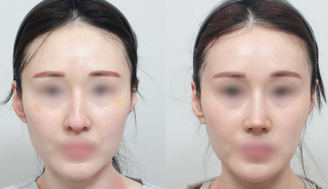 무보형 코성형 잘 어울리는 유형 관련 이미지 10