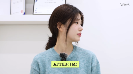 압구정 바바성형외과 자가늑 코성형 후기｜복코&middot;매부리코 교정 한달차 변화 관련 이미지 23