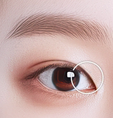 쌍수만으로 충분할까? 윗트임 병행이 필요한 경우 관련 이미지 10