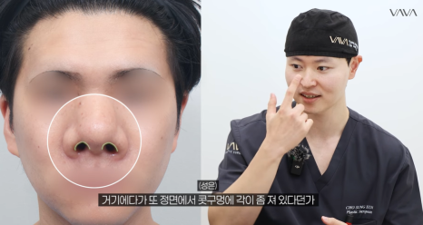 2026년 코성형 트렌드 예측콧대에서 코끝, 그리고 콧구멍까지 보는 시대 관련 이미지 12