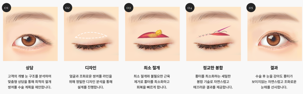 쌍꺼풀 수술 짧은 회복기 가능? 종류별 차이 완전 정리 관련 이미지 11