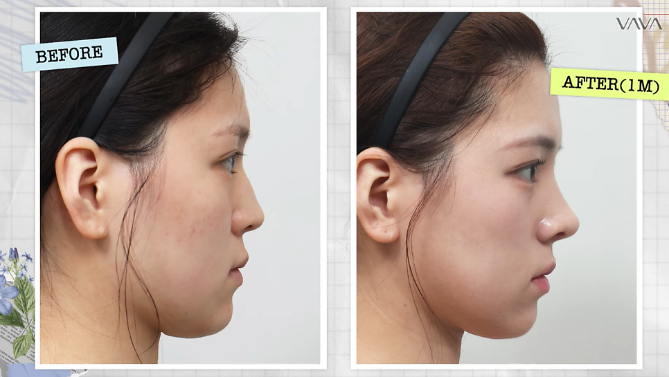 보형물 없이 선명하게｜바바성형외과 무보형물 매부리코 교정 리얼 후기 관련 이미지 1