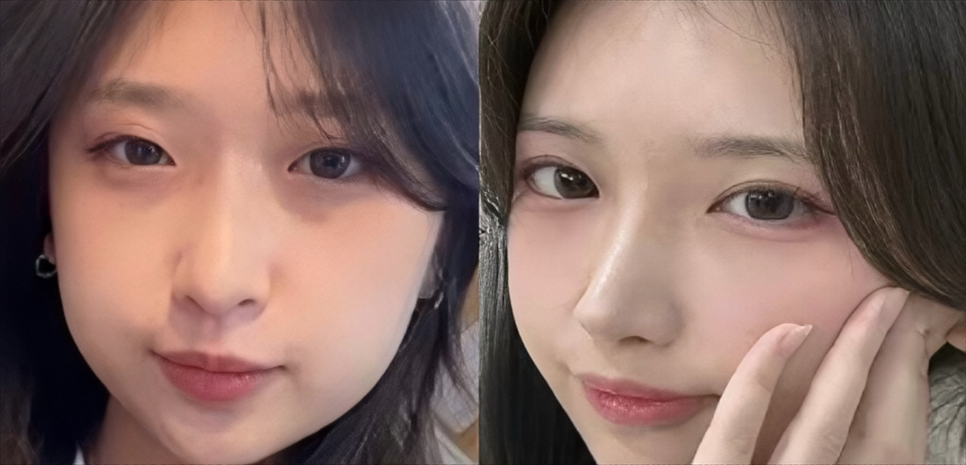 눈이랑 코 같이 하면 더 예뻐질까? ㅣ  동시성형 솔직 정리 관련 이미지 1