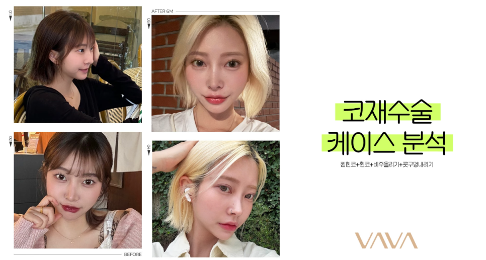 코재수술 원인, 과연 코끝처짐만이 문제일까? 가장 이상적인 라인 알려드립니다 관련 이미지 12